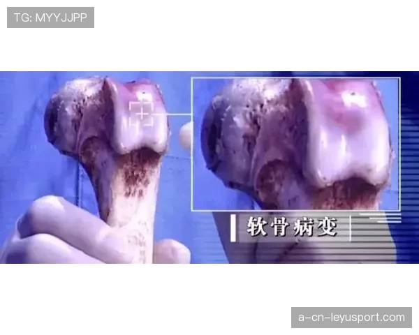 半月板切除:把软骨拿掉,职业生涯也切掉一块,半月板切了有什么影响